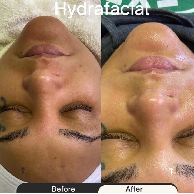 Hydrafacial Membership
